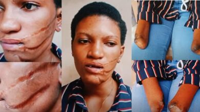 Photo de Une jeune femme révèle comment sa mère lui aurait coupé la main et lacéré le visage avec la machette
